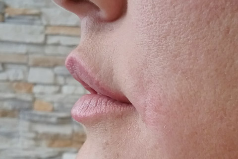 Lippen-seitansicht-nachher-2