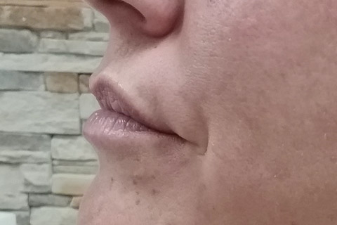 Lippen-seitansicht-vorher-2